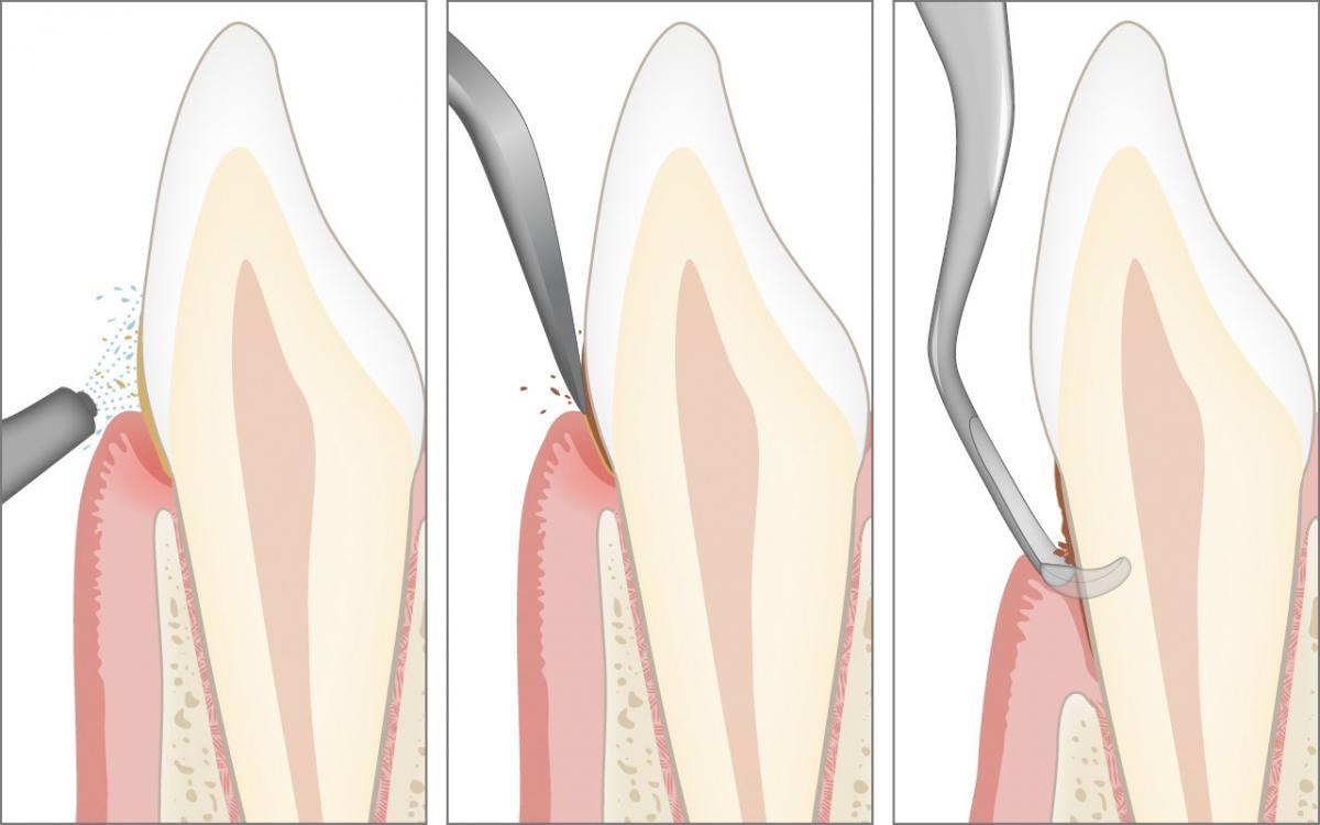 Regelmässige professionelle Zahnreinigung